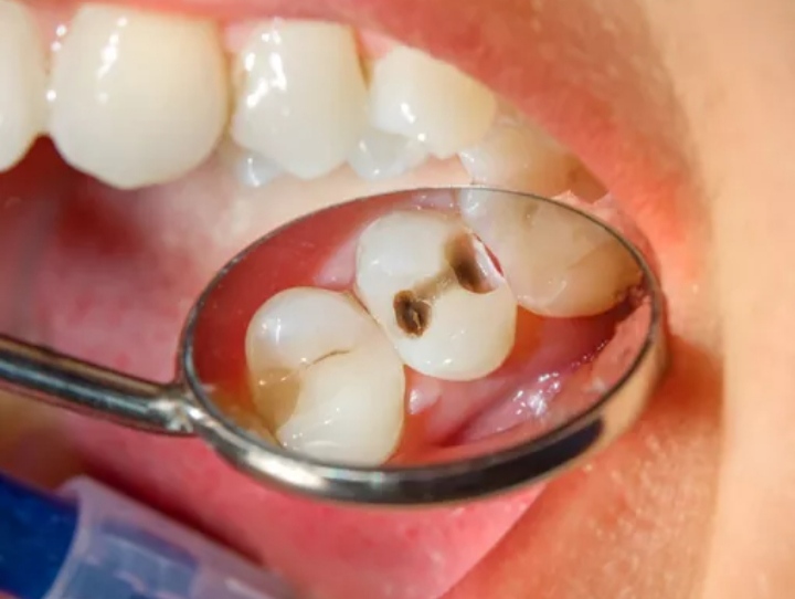 Gigi anda berlubang?, Berikut beberapa penyebab dan solusinya bagi anda 