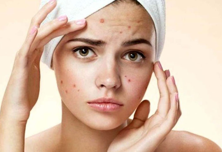Cara Mengatasi wajah Bruntusan Akibat Skincare, 5 Hal Ini perlu diperhatikan untuk Mengatasinya.