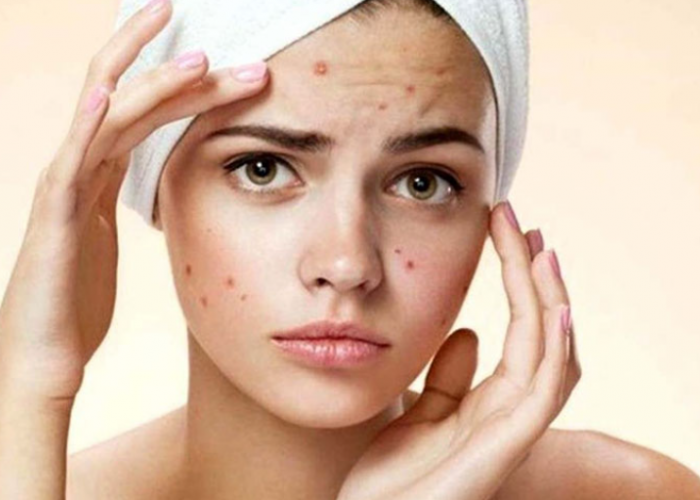 Cara Mengatasi wajah Bruntusan Akibat Skincare, 5 Hal Ini perlu diperhatikan untuk Mengatasinya.